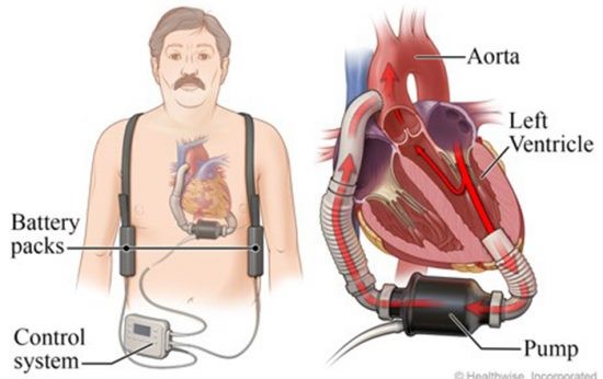yapay kalp sağlığı riskleri yüksek tansiyonun varsa ip atlayabilirsin